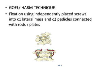 • GOEL/ HARM TECHNIQUE
• Fixation using independently placed screws
into c1 lateral mass and c2 pedicles connected
with rods r plates
 