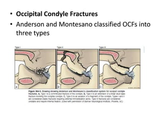• Occipital Condyle Fractures
• Anderson and Montesano classified OCFs into
three types
 