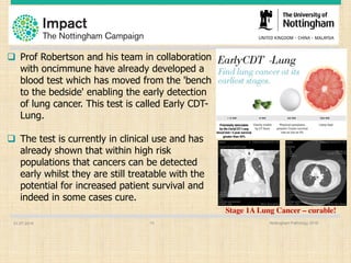 01.07.2016 Nottingham Pathology 201610
q Prof Robertson and his team in collaboration
with oncimmune have already developed a
blood test which has moved from the 'bench
to the bedside' enabling the early detection
of lung cancer. This test is called Early CDT-
Lung.
q The test is currently in clinical use and has
already shown that within high risk
populations that cancers can be detected
early whilst they are still treatable with the
potential for increased patient survival and
indeed in some cases cure.
Stage 1A Lung Cancer – curable!
 