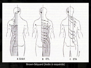 Brown-Séquard (lesão à esquerda) 
Grácil 
ETL 
ETA  