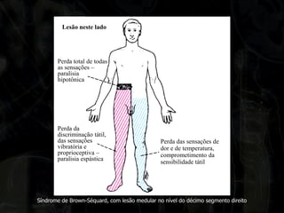 Síndrome de Brown-Séquard, com lesão medular no nível do décimo segmento direito 
Lesão neste lado 
Perda total de todas as sensações – paralisia hipotônica 
Perda da discriminação tátil, das sensações vibratória e proprioceptiva – paralisia espástica 
Perda das sensações de dor e de temperatura, comprometimento da sensibilidade tátil  