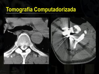 Tomografia Computadorizada  