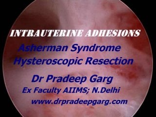 Intrautterine adhsions ; Asherman Syndrome ; Dr Pradeep Garg M0b; 7289915430