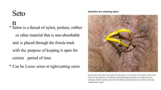 FISTULA IN ANO GENERAL SURGERY RECTAL EXAMINATION | PPTX