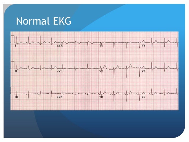 what does afib look like on ecg what does afib look like on ecg