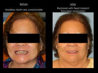 Before After
Maxillary teeth are unrestorable
Restored with fixed implant
Porcelain restoration
 