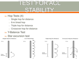 Hop Test Pass ACL Repair and Return To Play | PPTX
