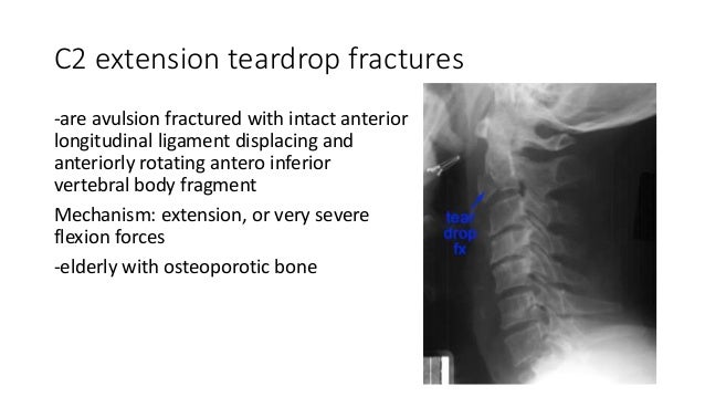 icd 10 odontoid fracture icd 10 odontoid fracture