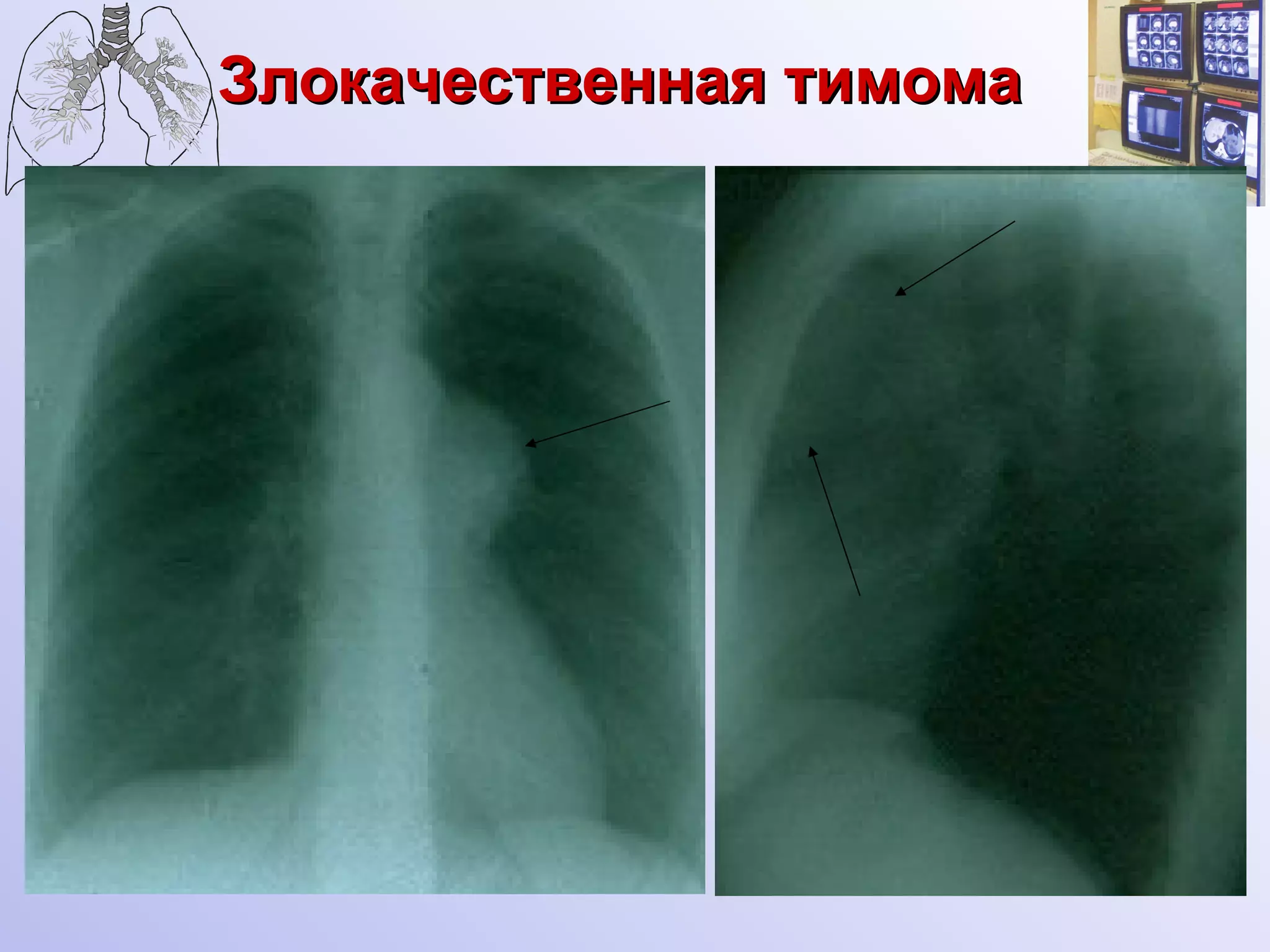 Злокачественная тимома 