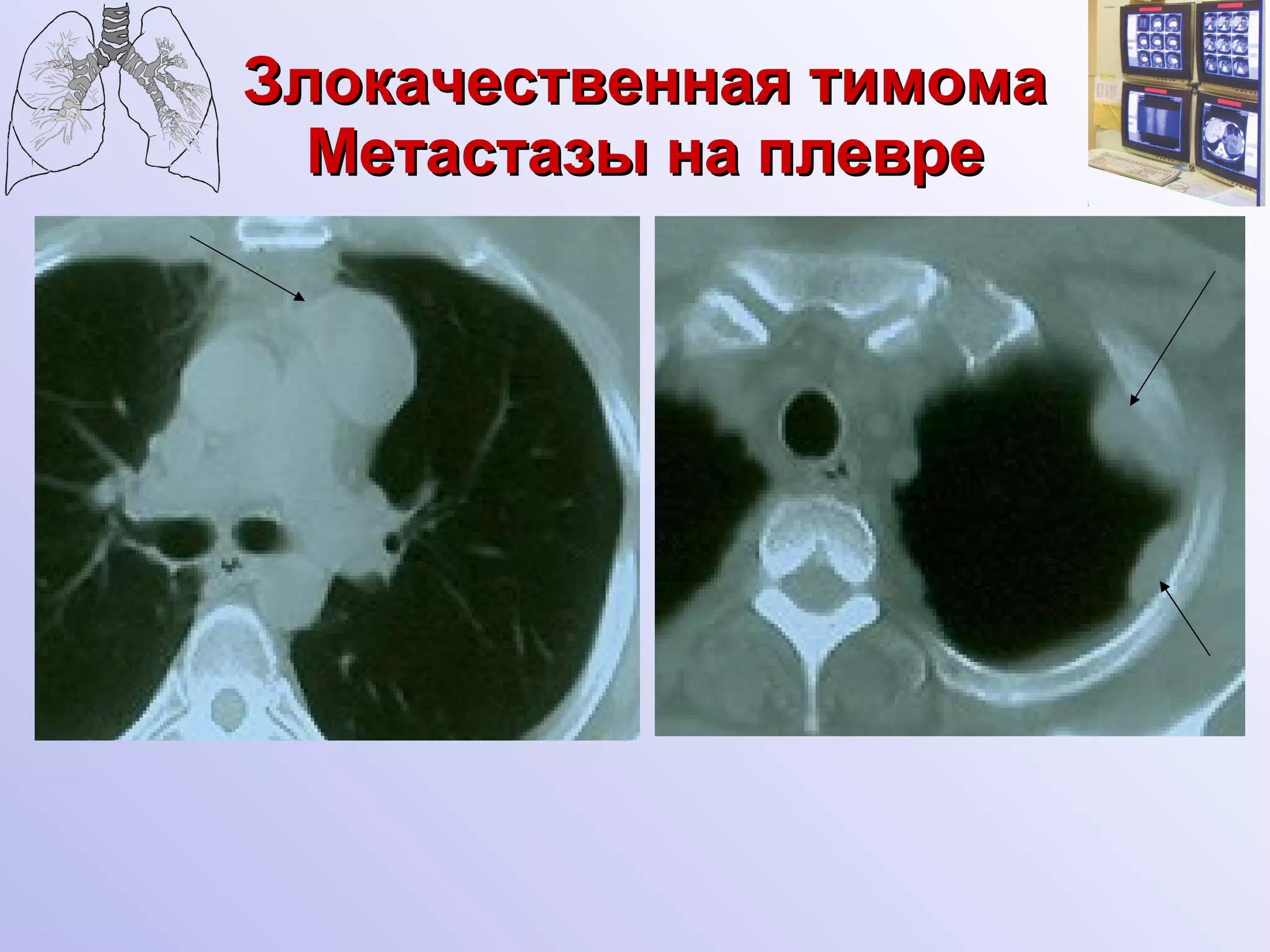 Злокачественная тимома Метастазы на плевре 