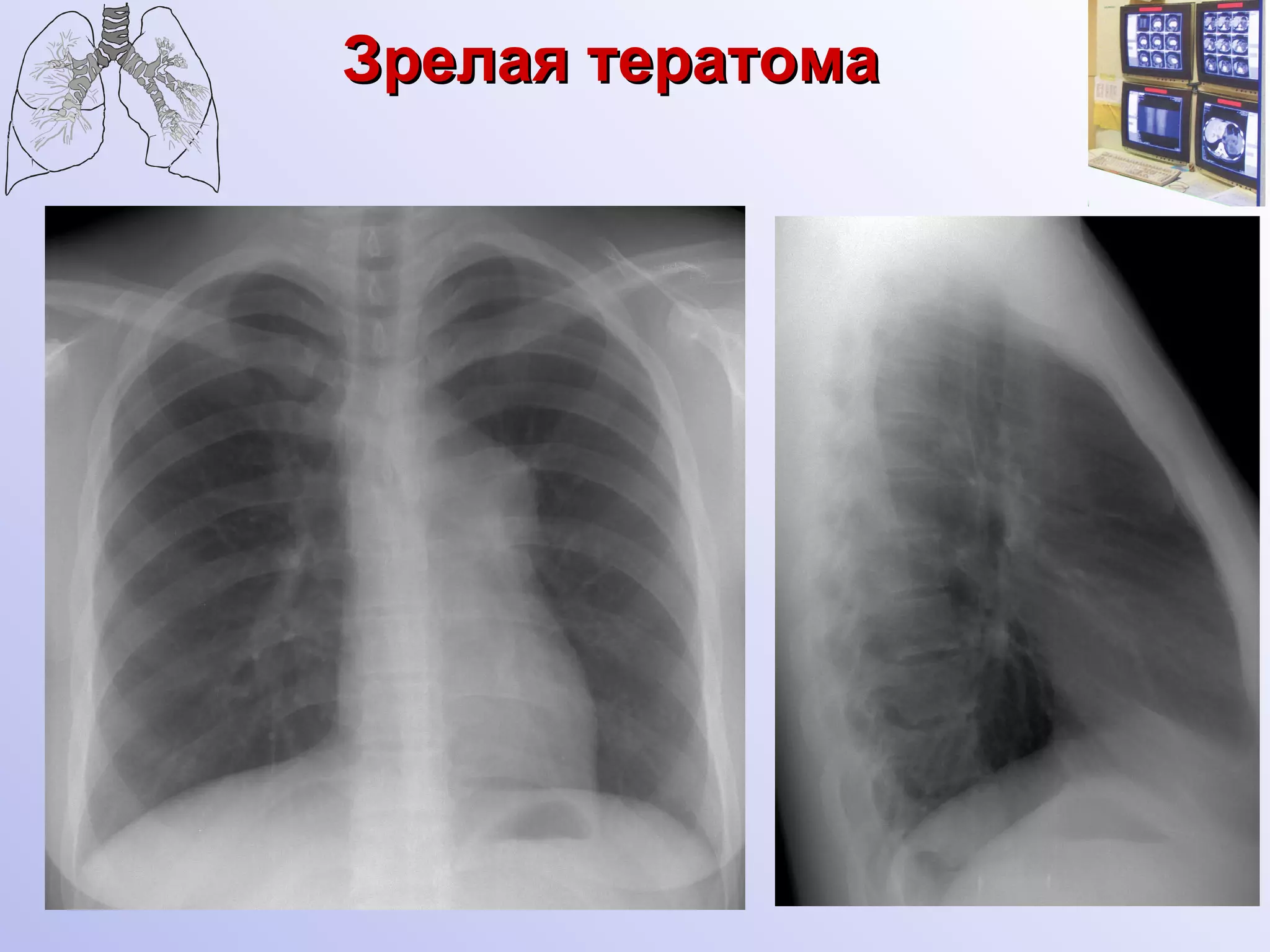 Зрелая тератома 