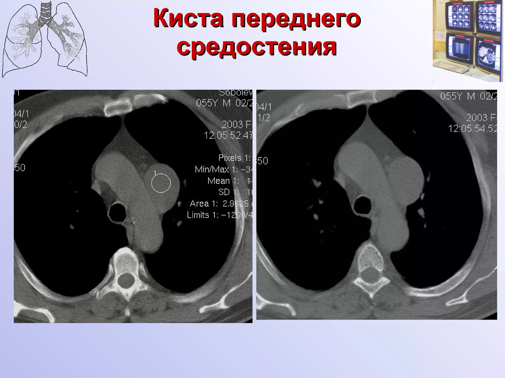 Киста переднего средостения 