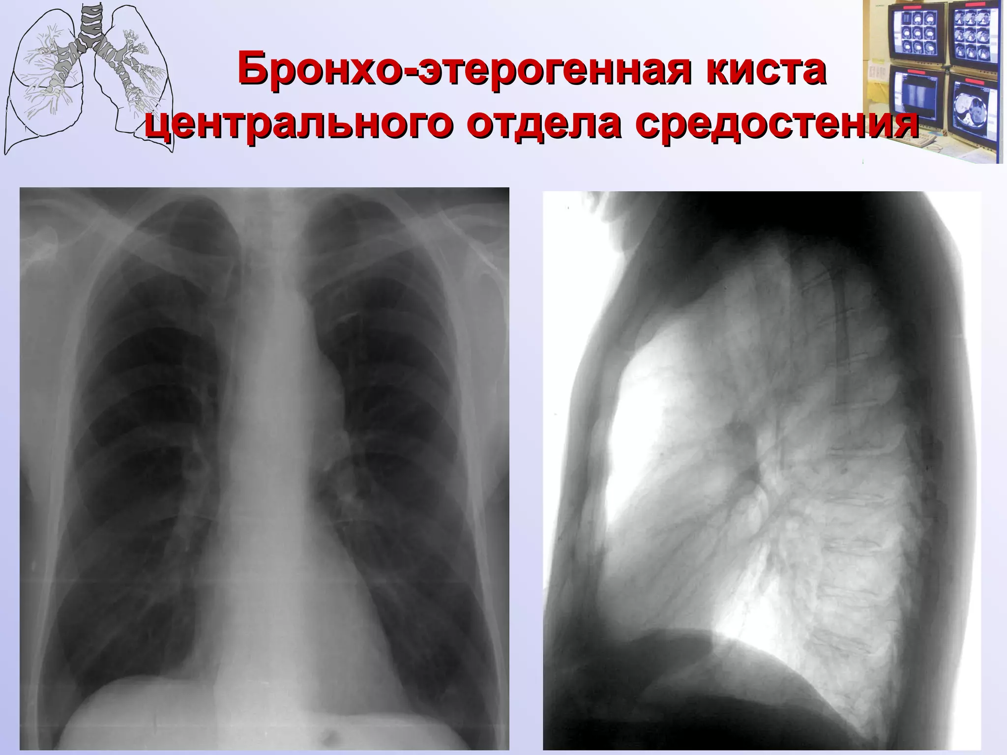 Бронхо-этерогенная киста центрального отдела средостения 