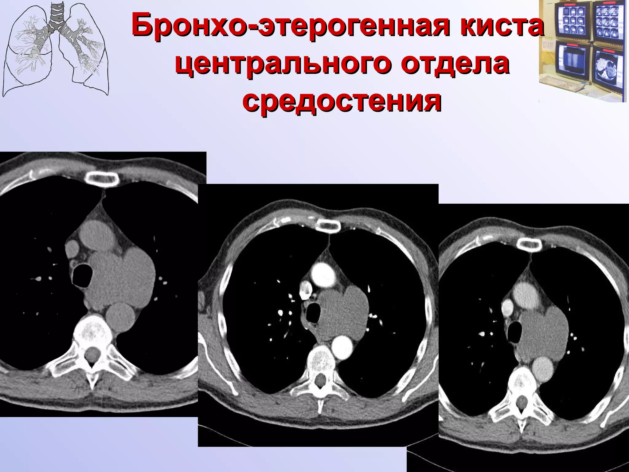Бронхо-этерогенная киста центрального отдела средостения 