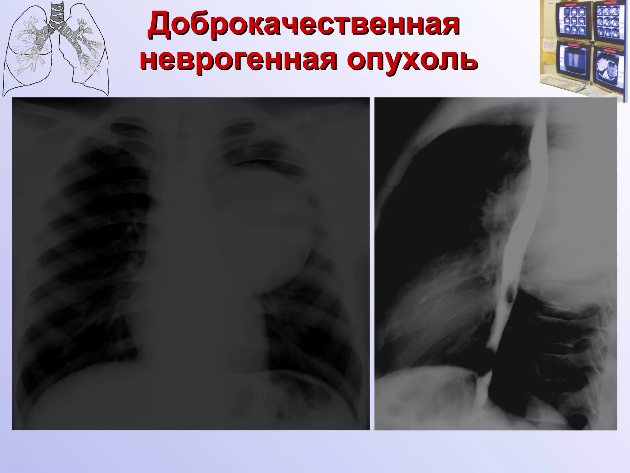 Доброкачественная  неврогенная опухоль 