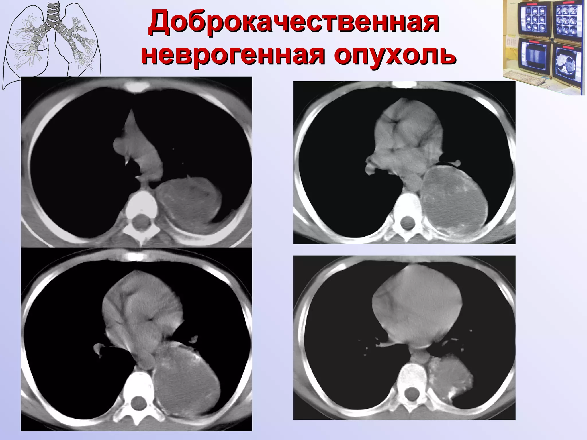 Доброкачественная  неврогенная опухоль 