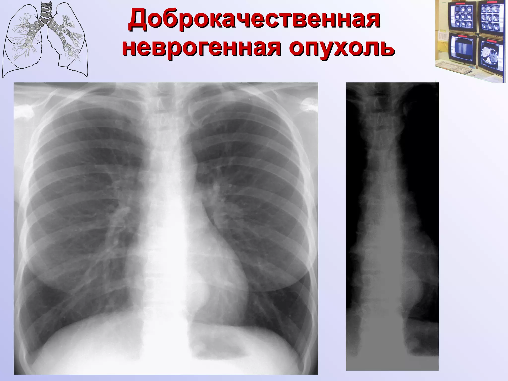 Доброкачественная  неврогенная опухоль 