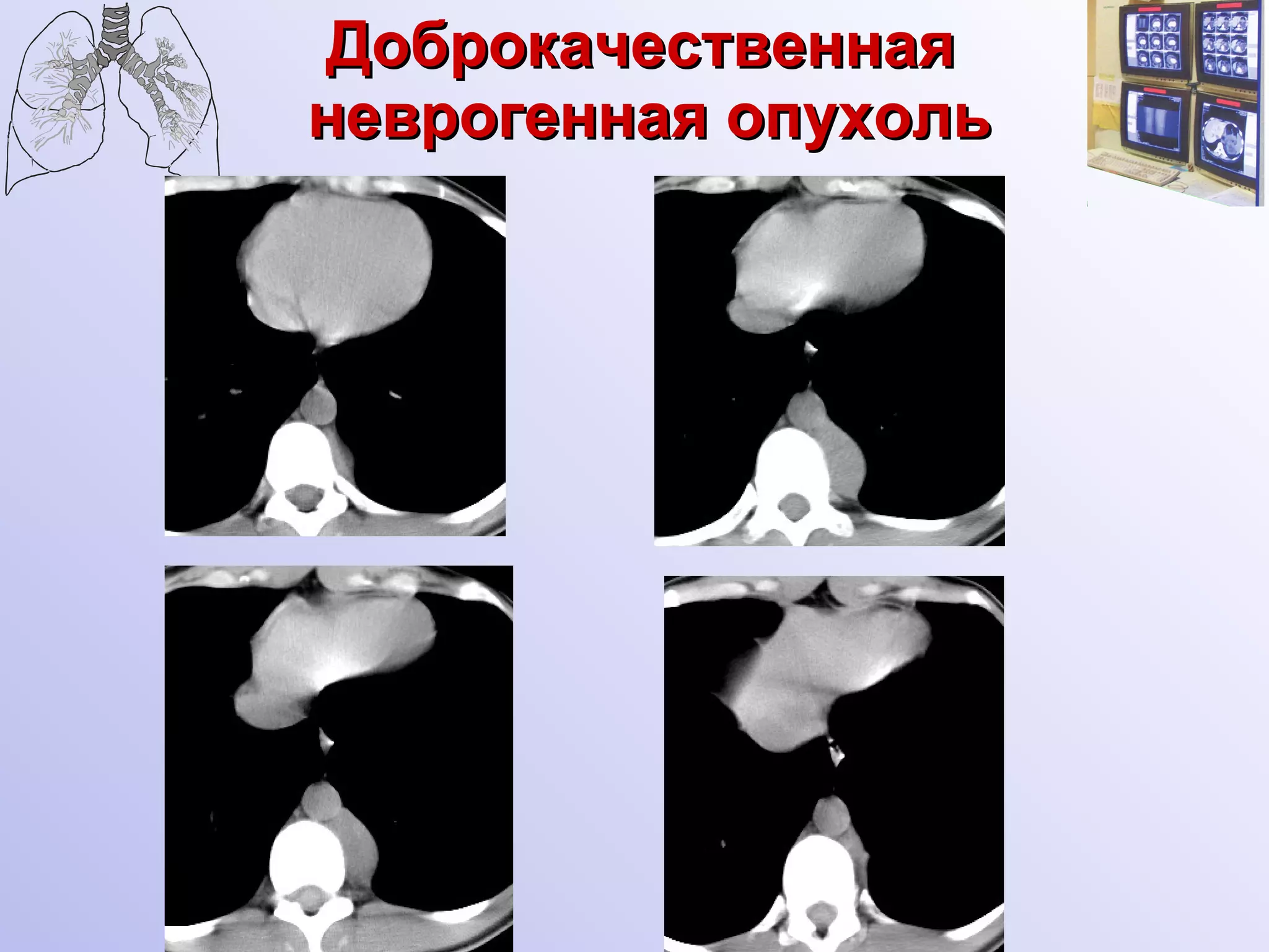 Доброкачественная  неврогенная опухоль 