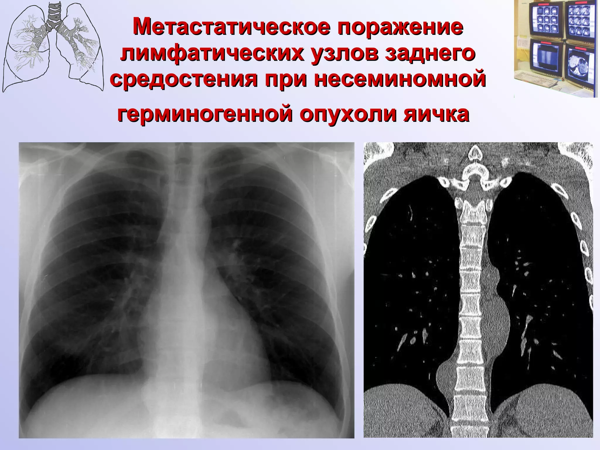 Метастатическое поражение лимфатических узлов заднего средостения при несеминомной герминогенной опухоли яичка   