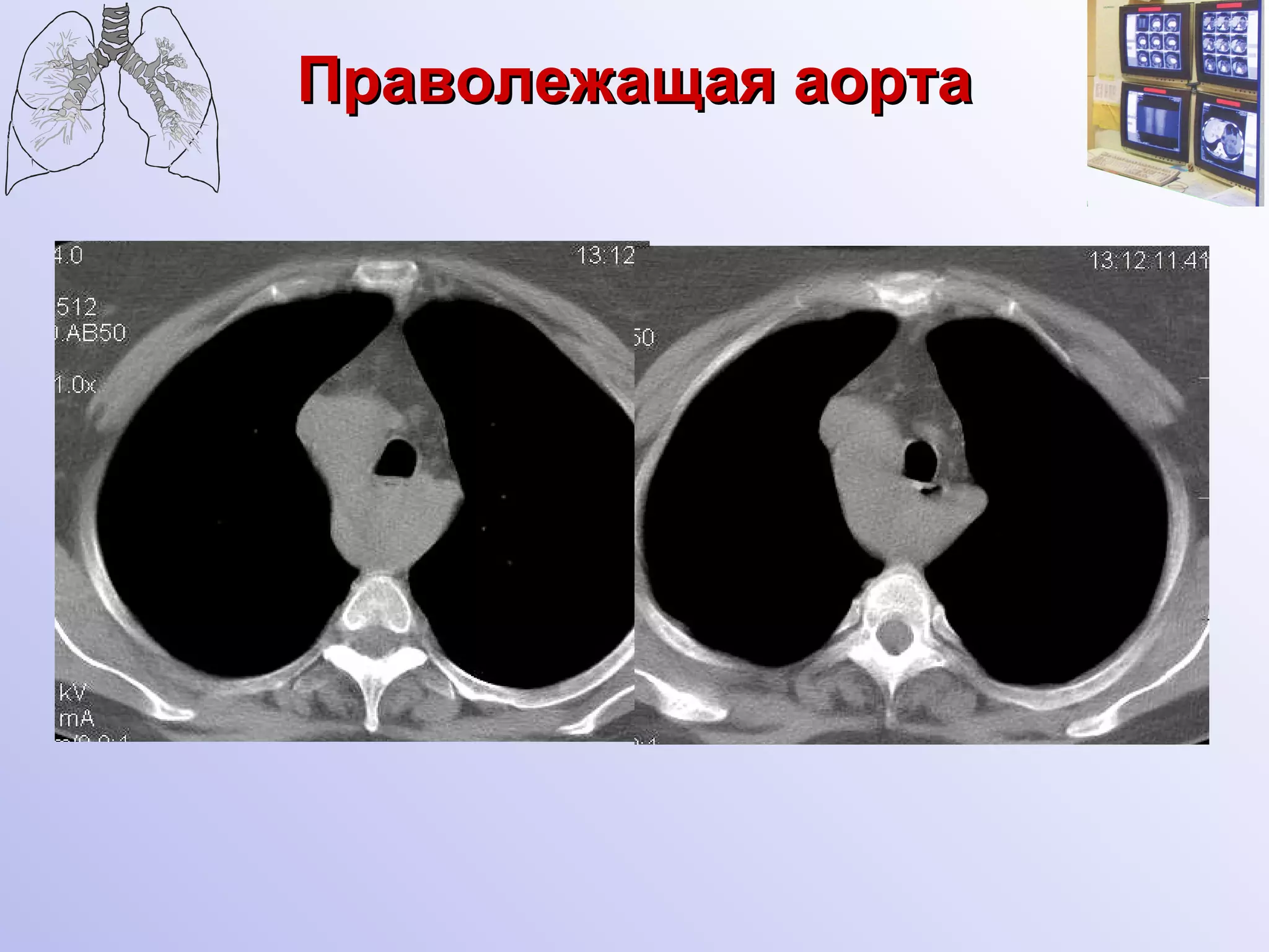 Праволежащая аорта 