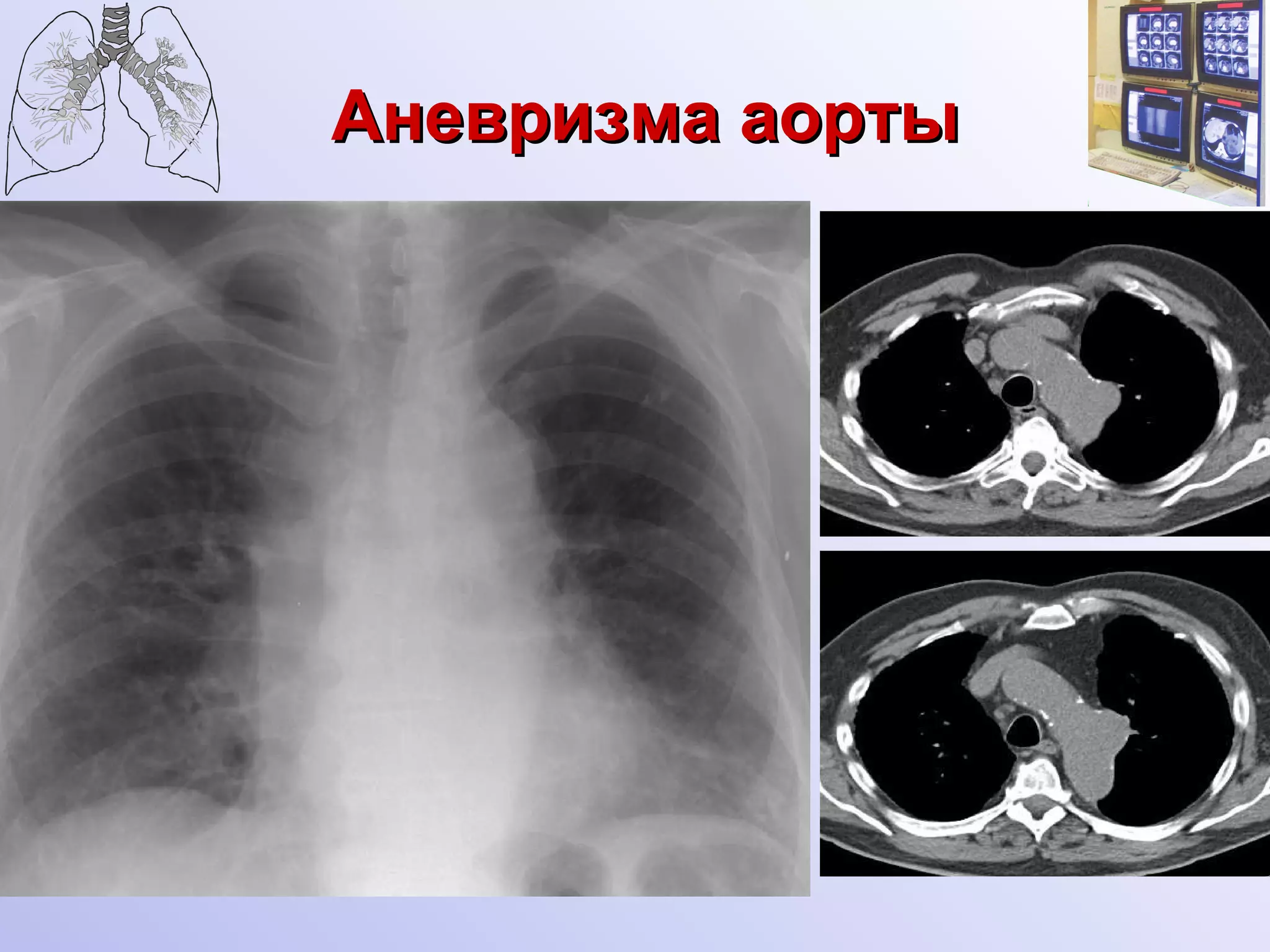 Аневризма аорты 