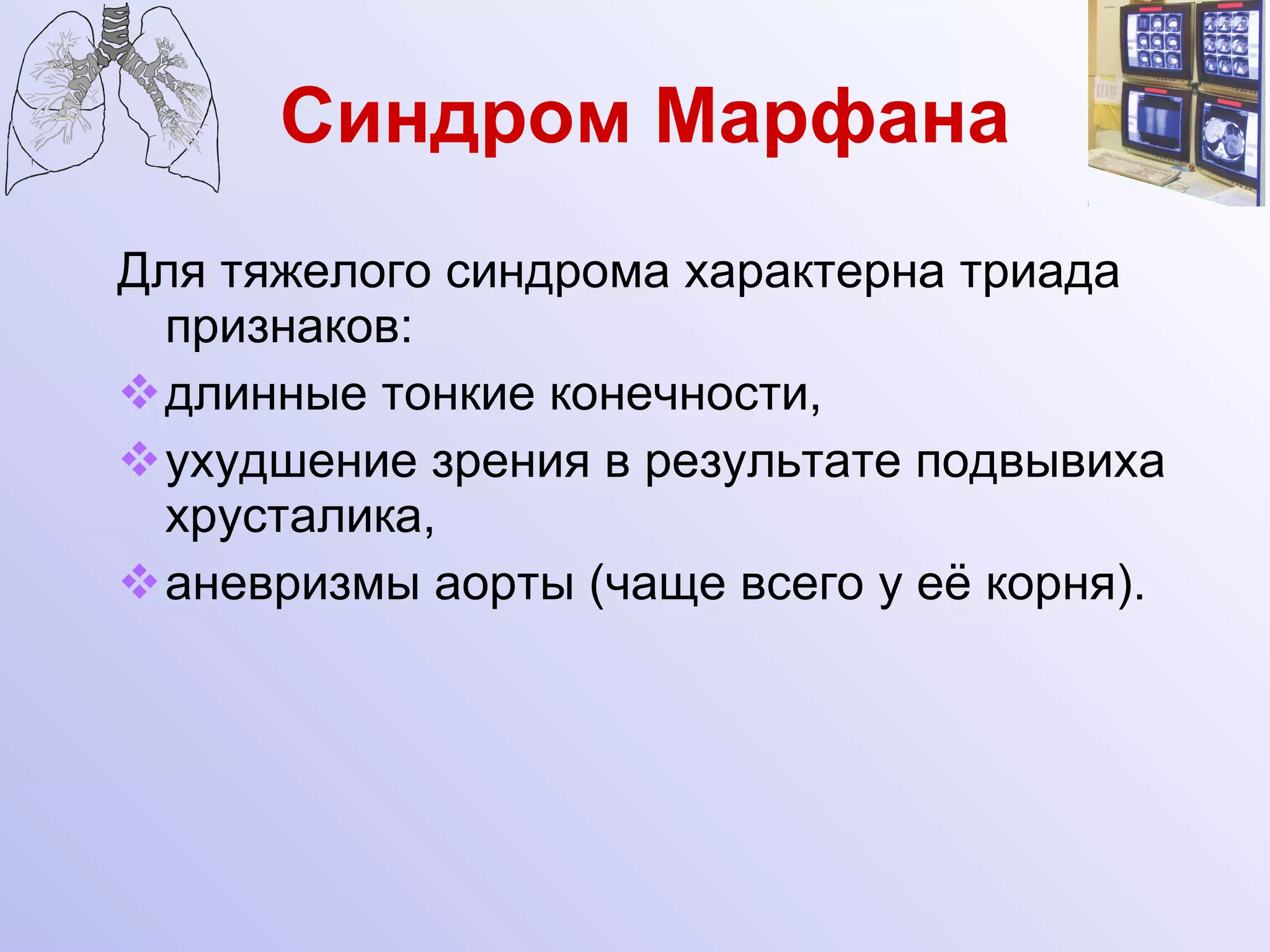 Синдром Марфана Для тяжелого синдрома характерна триада признаков: длинные тонкие конечности, ухудшение зрения в результате подвывиха хрусталика, аневризмы аорты (чаще всего у её корня). 