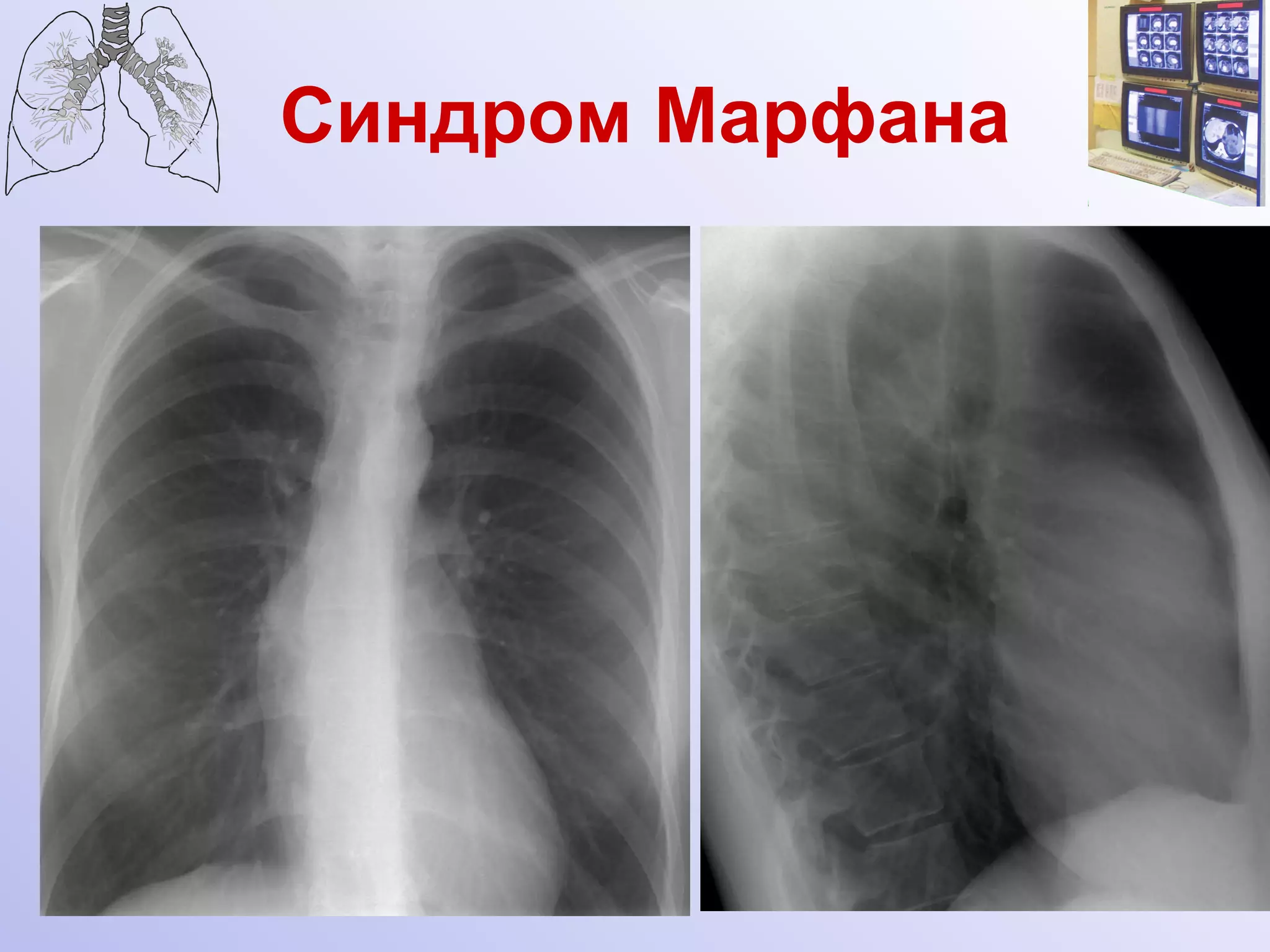 Синдром Марфана 