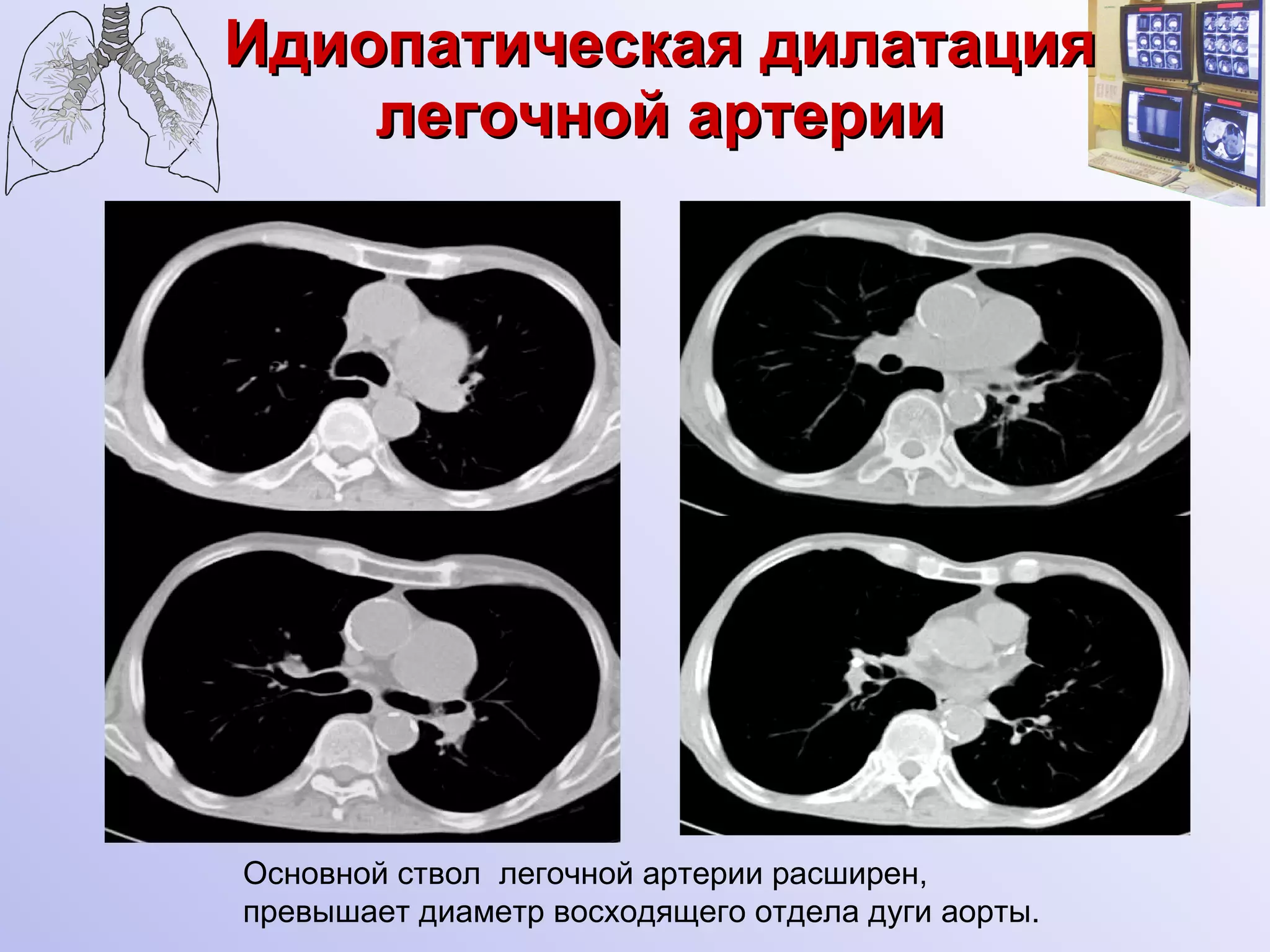 Идиопатическая дилатация легочной артерии Основной ствол  легочной артерии расширен,  превышает диаметр восходящего отдела дуги аорты. 