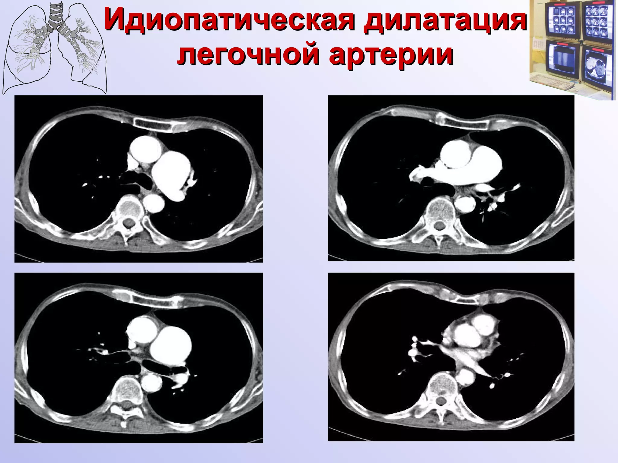 Идиопатическая дилатация легочной артерии 