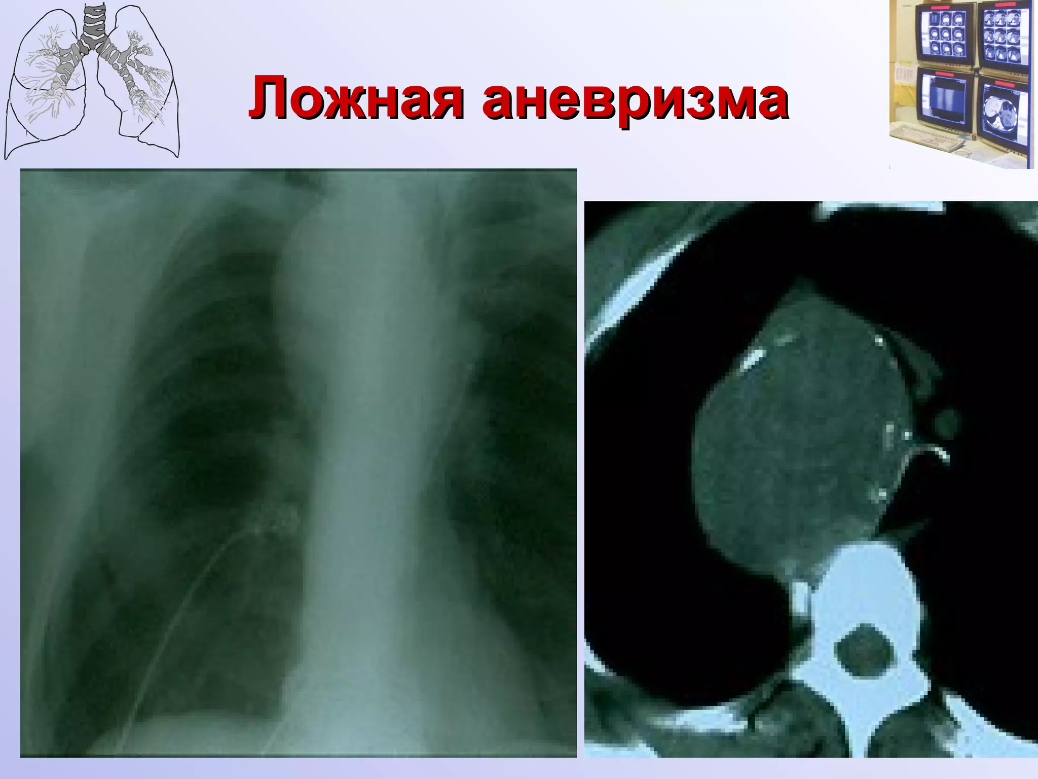 Ложная аневризма   