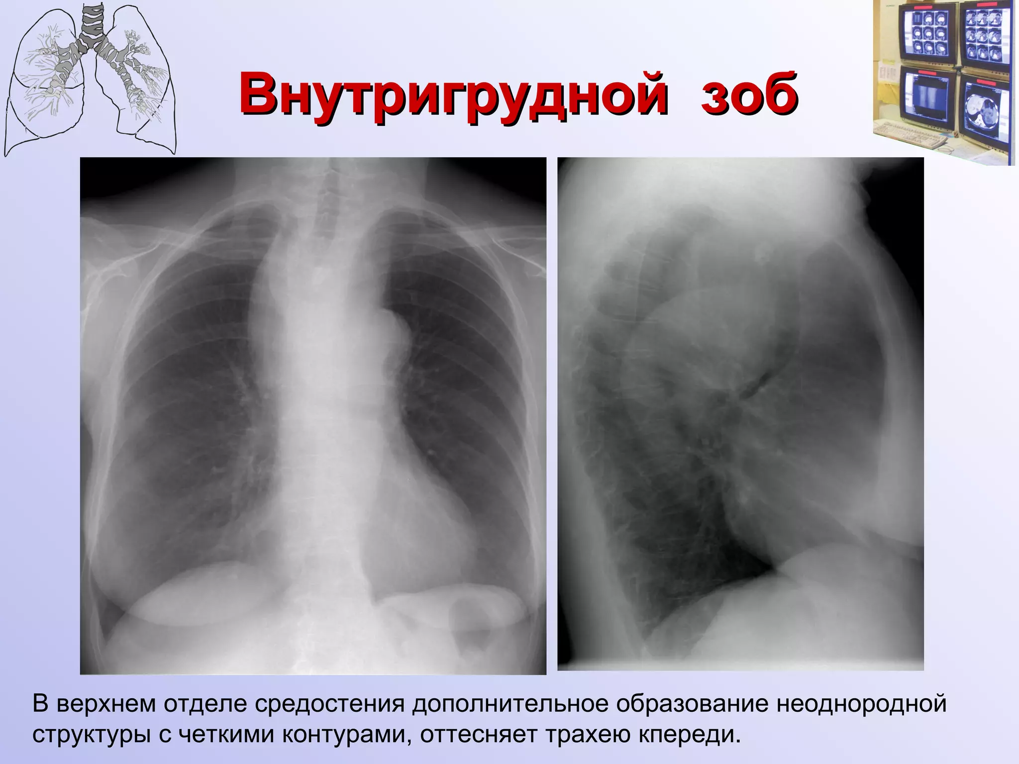Внутригрудной  зоб В верхнем отделе средостения дополнительное образование неоднородной  структуры с четкими контурами, оттесняет трахею кпереди. 