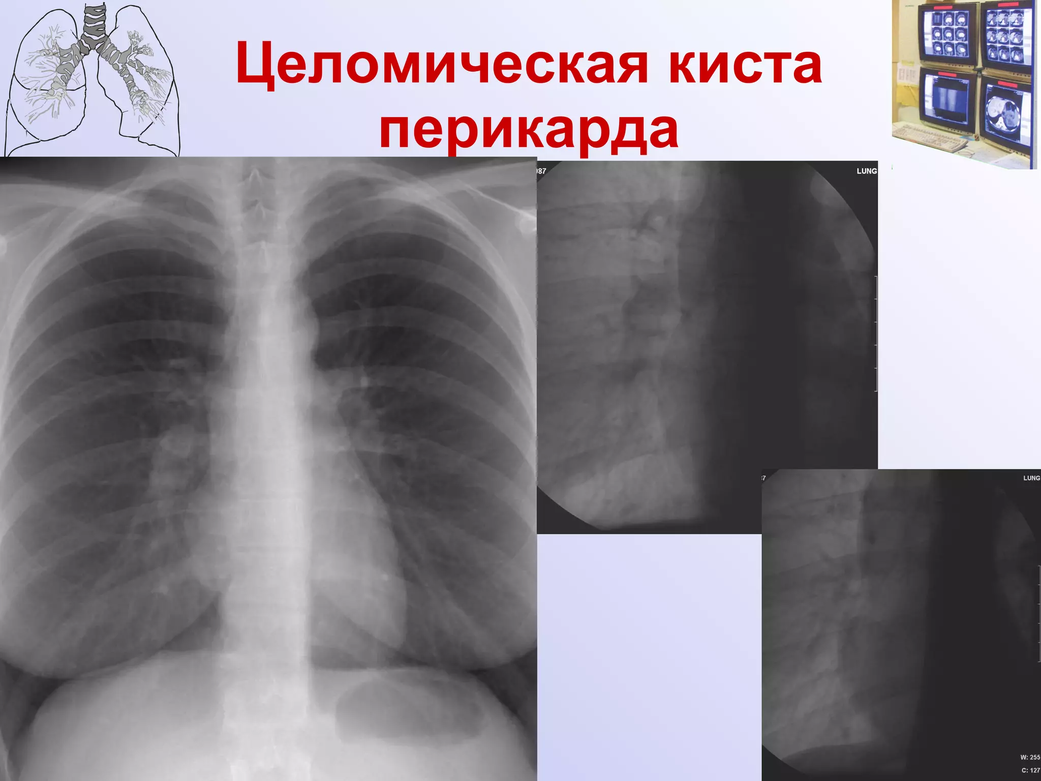 Целомическая киста перикарда 