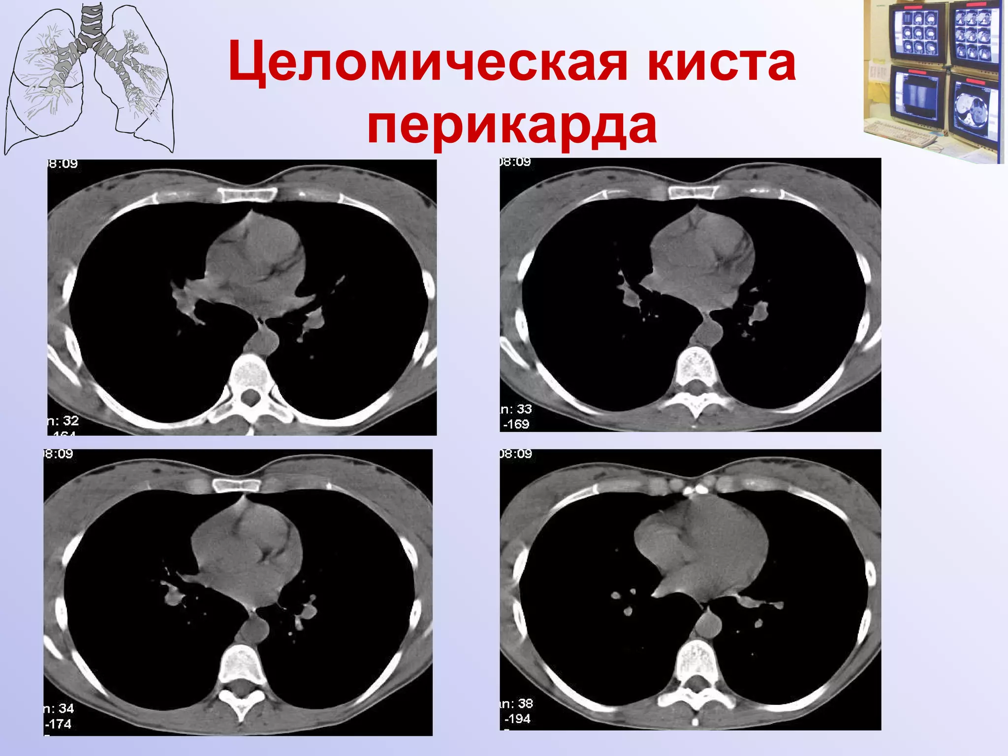 Целомическая киста перикарда 