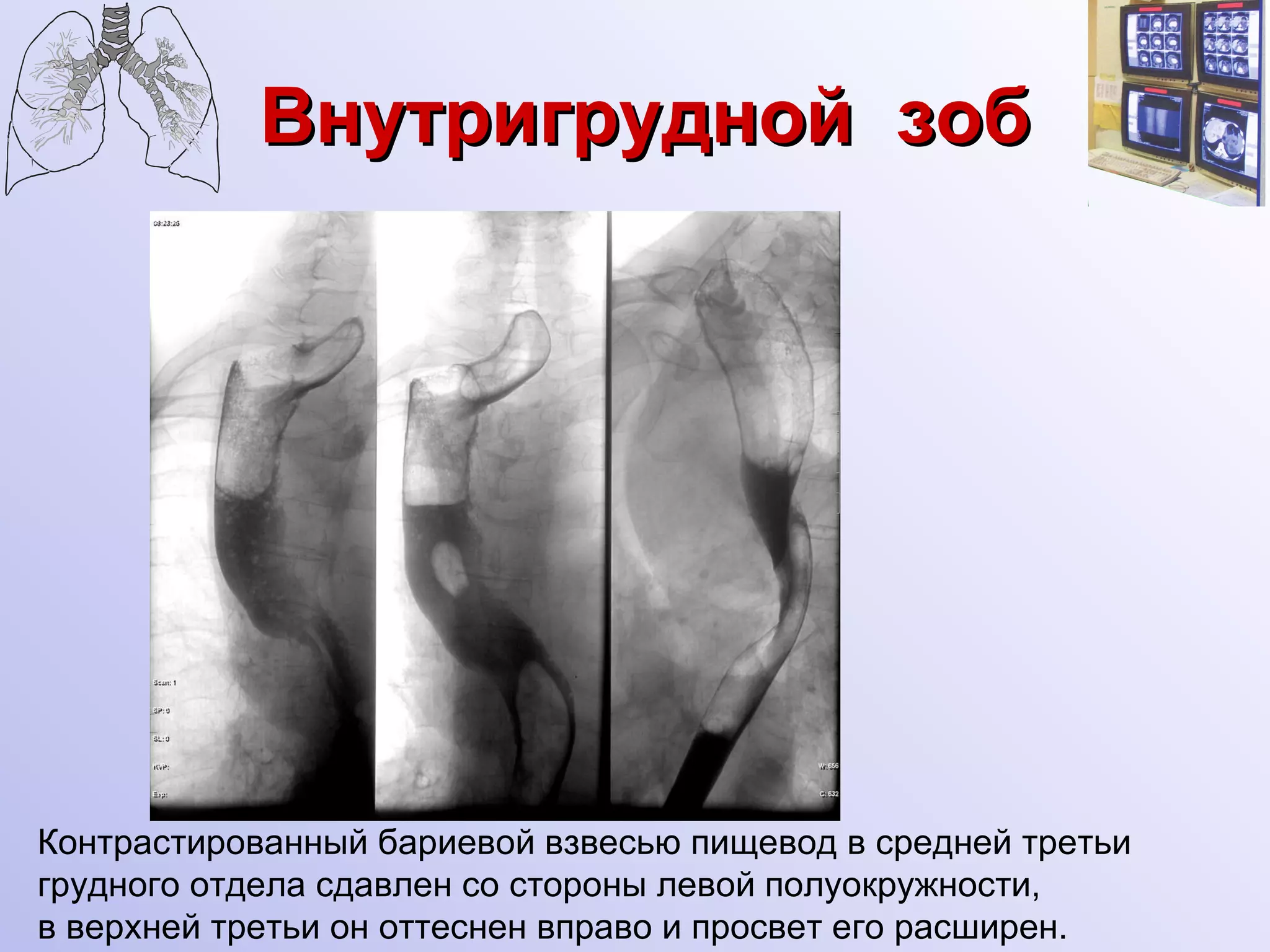 Внутригрудной  зоб Контрастированный бариевой взвесью пищевод в средней третьи  грудного отдела сдавлен со стороны левой полуокружности, в верхней третьи   он оттеснен вправо   и   просвет его расширен. 