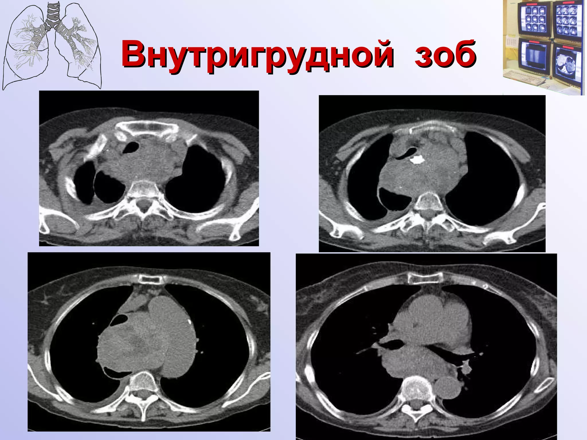 Внутригрудной  зоб 