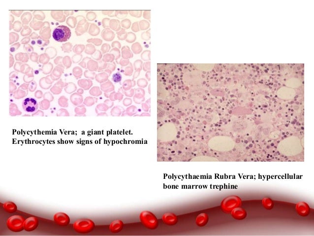 polycythemia polycythemia rubra vera