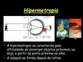 Hipermetropia
• A hipermetropia se caracteriza pela
dificuldade de enxergar objetos próximos, ou
seja, a partir do ponto próximo ao olho.
• A imagem se forma depois da retina.
 
