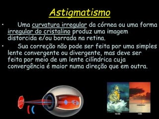 Astigmatismo
• Uma curvatura irregular da córnea ou uma forma
irregular do cristalino produz uma imagem
distorcida e/ou borrada na retina.
• Sua correção não pode ser feita por uma simples
lente convergente ou divergente, mas deve ser
feita por meio de um lente cilíndrica cuja
convergência é maior numa direção que em outra.
 