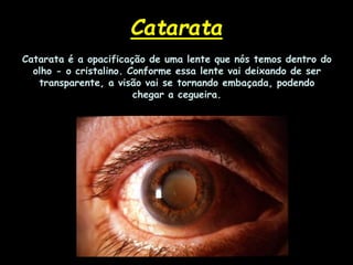 Catarata é a opacificação de uma lente que nós temos dentro do
olho - o cristalino. Conforme essa lente vai deixando de ser
transparente, a visão vai se tornando embaçada, podendo
chegar a cegueira.
Catarata
 