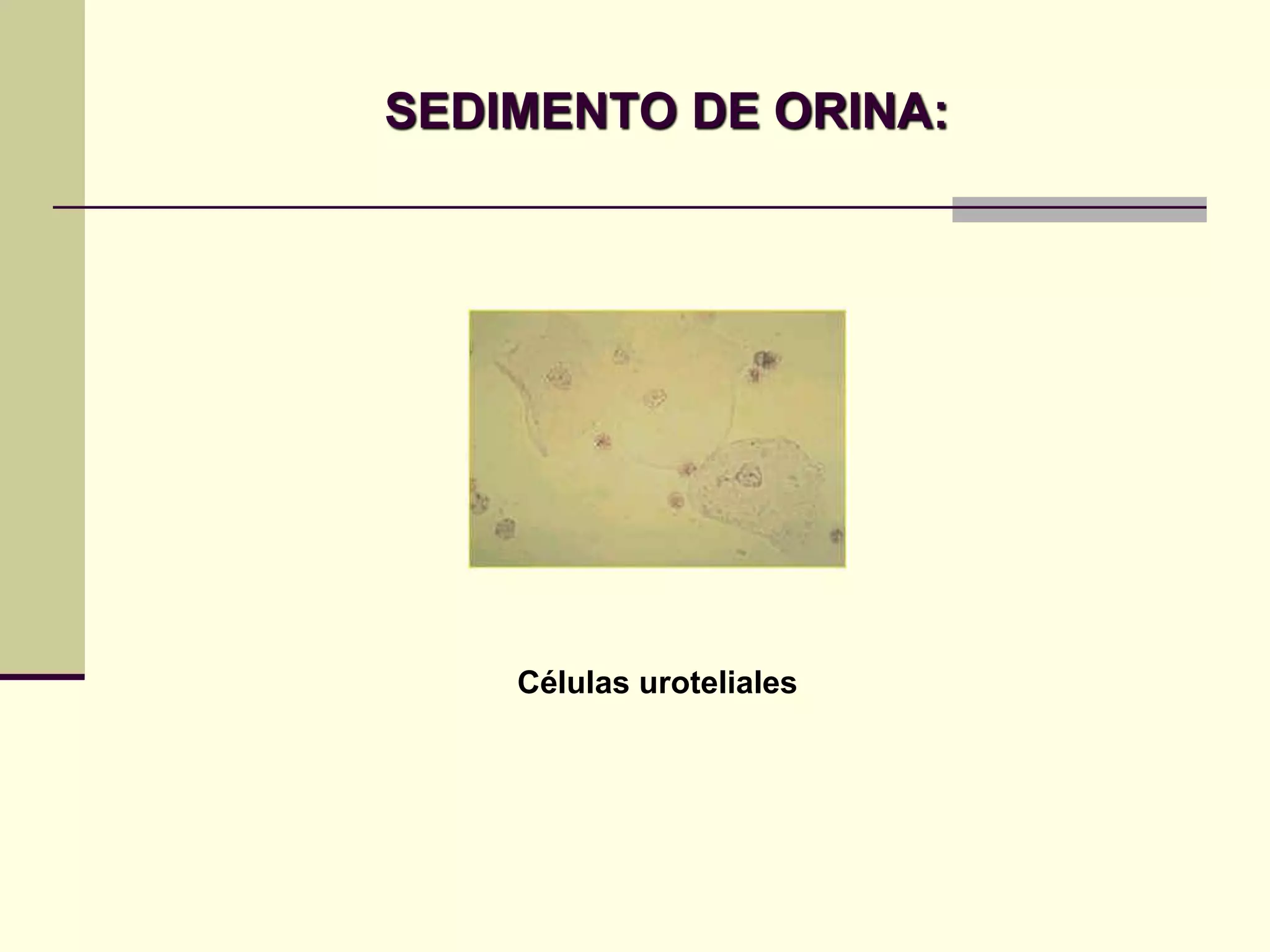 SEDIMENTO DE ORINA:




    Células uroteliales
 