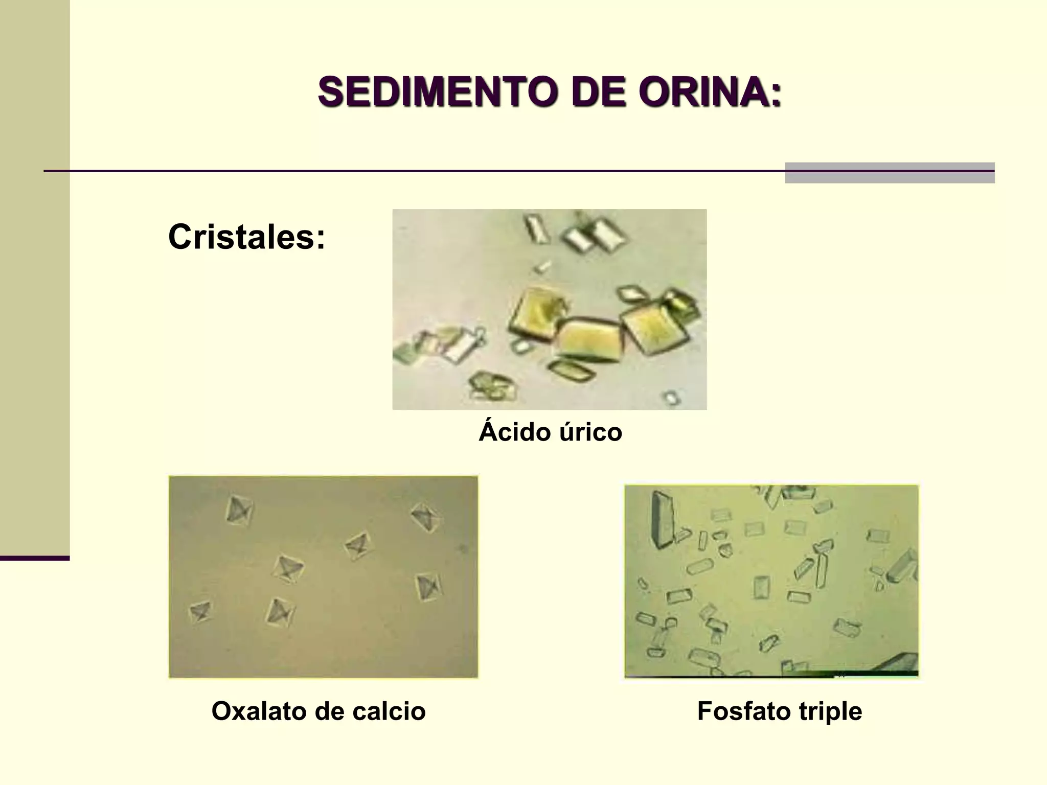 SEDIMENTO DE ORINA:


Cristales:




                      Ácido úrico

   Ácido úrico




  Oxalato de calcio                 Fosfato triple
 