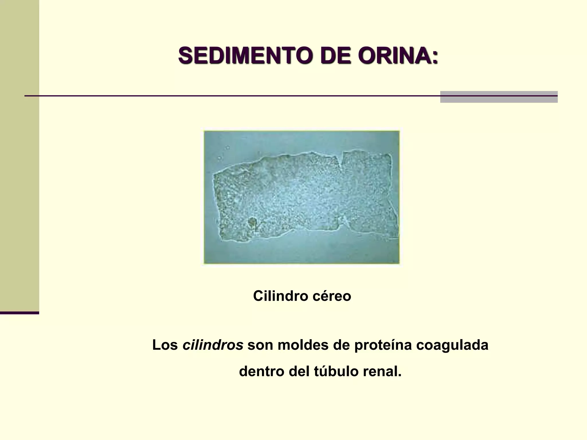 SEDIMENTO DE ORINA:




             Cilindro céreo


Los cilindros son moldes de proteína coagulada
           dentro del túbulo renal.
 