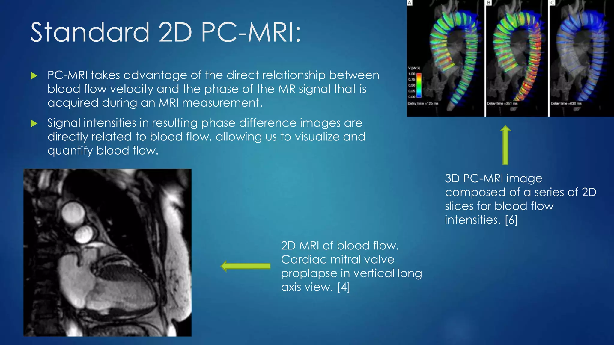 Standard 2D PC-MRI:
 PC-MRI takes advantage of the direct relationship between
blood flow velocity and the phase of the MR signal that is
acquired during an MRI measurement.
 Signal intensities in resulting phase difference images are
directly related to blood flow, allowing us to visualize and
quantify blood flow.
2D MRI of blood flow.
Cardiac mitral valve
proplapse in vertical long
axis view. [4]
3D PC-MRI image
composed of a series of 2D
slices for blood flow
intensities. [6]
 
