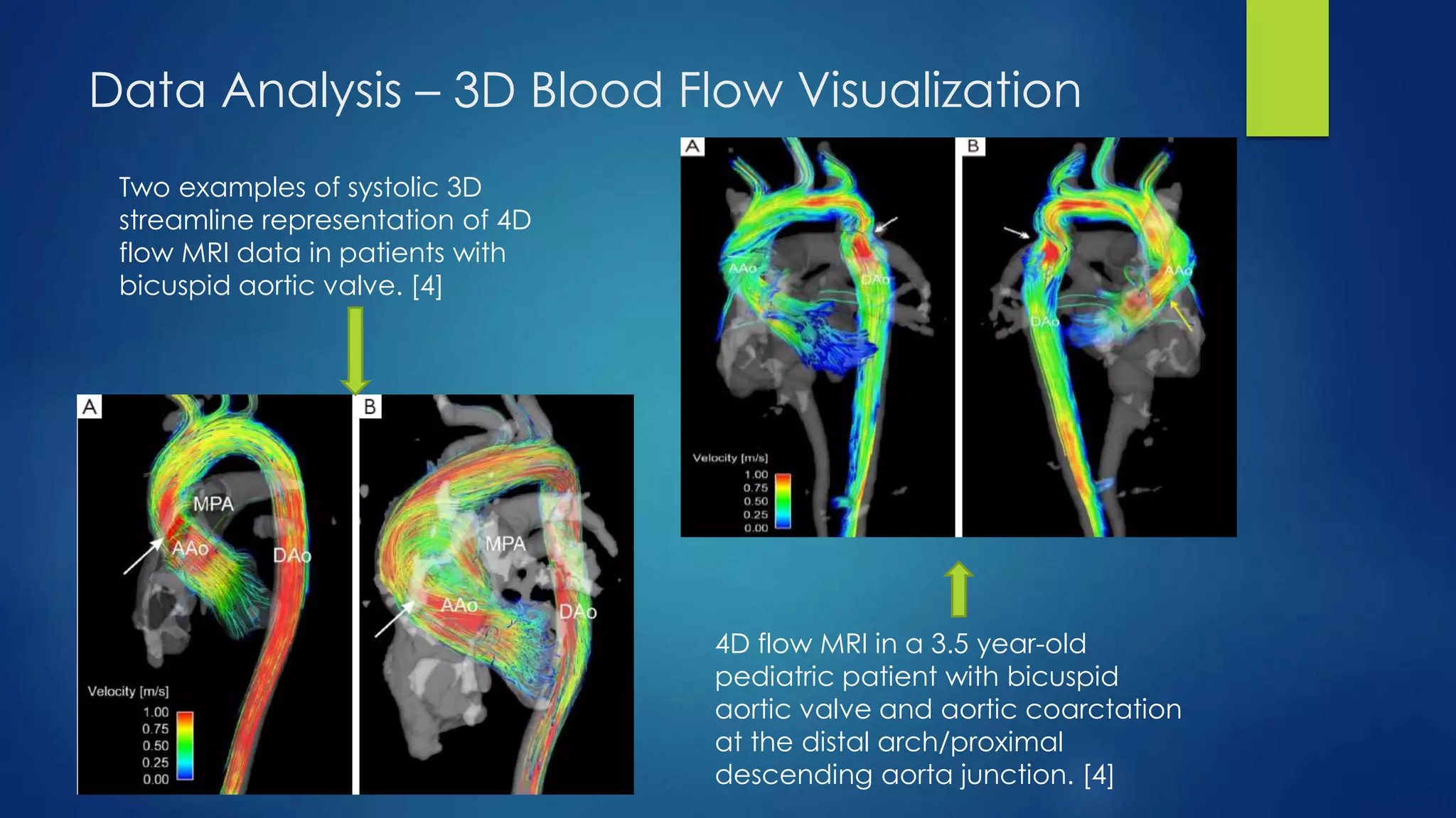 Data Analysis – 3D Blood Flow Visualization
Two examples of systolic 3D
streamline representation of 4D
flow MRI data in patients with
bicuspid aortic valve. [4]
4D flow MRI in a 3.5 year-old
pediatric patient with bicuspid
aortic valve and aortic coarctation
at the distal arch/proximal
descending aorta junction. [4]
 
