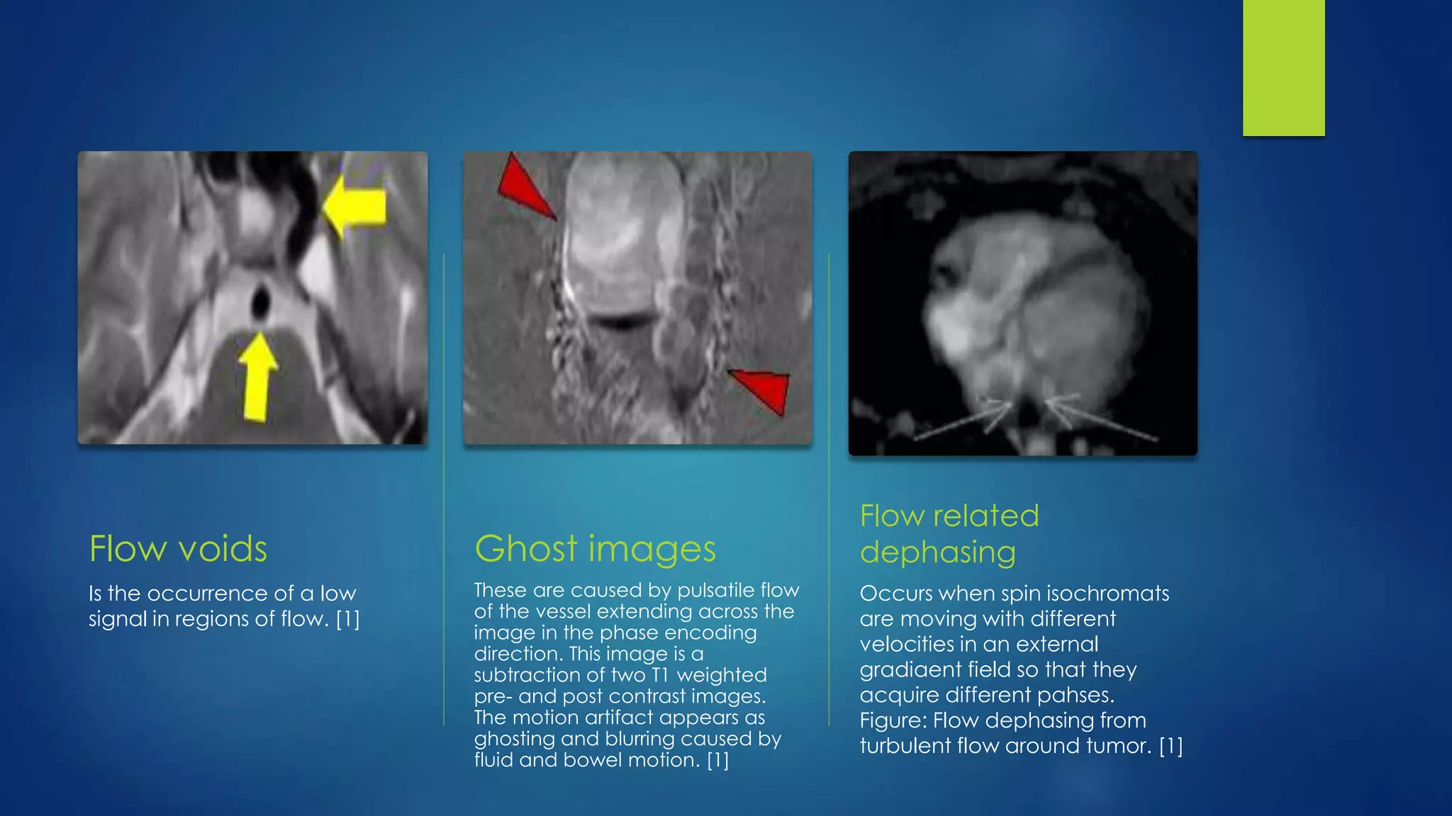Flow voids
Is the occurrence of a low
signal in regions of flow. [1]
Ghost images
These are caused by pulsatile flow
of the vessel extending across the
image in the phase encoding
direction. This image is a
subtraction of two T1 weighted
pre- and post contrast images.
The motion artifact appears as
ghosting and blurring caused by
fluid and bowel motion. [1]
Flow related
dephasing
Occurs when spin isochromats
are moving with different
velocities in an external
gradiaent field so that they
acquire different pahses.
Figure: Flow dephasing from
turbulent flow around tumor. [1]
 