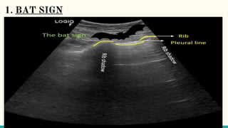 trans thoracic ultrasound of chest | PPTX