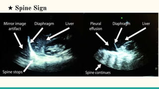 Spine Sign Fast trans thoracic ultrasound of chest | PPTX