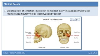 Ismail Fadhil Abbas, MD M.B.Ch.B
Anatomy of Trigeminal nerve
1- Unilateralloss of sensation:may result from direct injury in associationwith facial
fractures (particularly V2) or localinvasionby cancer.
Clinical Points
 