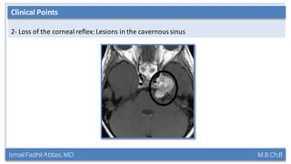 Ismail Fadhil Abbas, MD M.B.Ch.B
Anatomy of Trigeminal nerve
2- Loss of the corneal reflex: Lesions in the cavernous sinus
Clinical Points
 