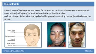 Ismail Fadhil Abbas, MD M.B.Ch.B
Anatomy of Trigeminal nerve
1- Weakness of both upper and lower facialmuscles: unilaterallower motor neurone VII
nerve lesion (bell’s palsy) in which there is the patientis unable
to close his eye. As he tries, the eyeballrolls upwards, exposing the conjunctivabelow the
cornea.
Clinical Points
 